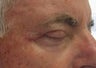 This patient presented with a squamous cell carcinoma of his right upper lid . Marking pen was drawn around the