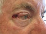 This patient presented with a squamous cell carcinoma of his right upper lid . Marking pen was drawn around the