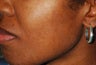 Female with Acne and Blemishes