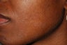 Female with Acne and Blemishes