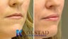 Lip Augmentation