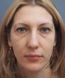Cosmetic Injectables: Botox & Restylane L ~ 1CC Lower Eyelids