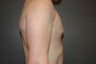 Bilateral keyhole approach. Incision limited to lower half of areola. Three month photo.