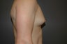 Bilateral keyhole approach. Incision limited to lower half of areola. Three month photo.