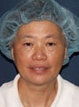 57 year old Asian female with age spots and brown spots