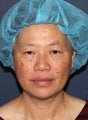 57 year old Asian female with age spots and brown spots