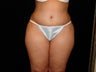 Abdominoplasty with Liposuction of Abdomen, Waist, Flanks, Dorsal Roll