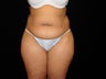 Abdominoplasty with Liposuction of Abdomen, Waist, Flanks, Dorsal Roll