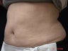 Coolsculpting