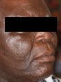 Male Patient Treated with Sculptra