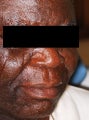 Male Patient Treated with Sculptra