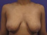 25 Year Old Girl Before and After Breast Lift
