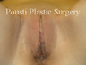 Labial Reduction