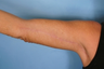Arm Lift