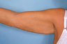 Arm Lift