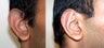 Otoplasty ("Ear Pinning")