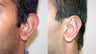 Otoplasty ("Ear Pinning")