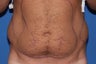 Vaser Liposelect, Male