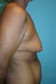 Breast Lift