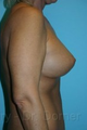 Breast Lift