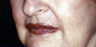 Full Face Erbium Laser Resurfacing