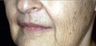 Full Face Erbium Laser Resurfacing