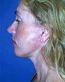 face/neck lift