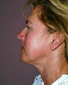 face/neck lift
