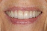 This patient presented with defective restorations and cavities. She had all her teeth top teeth restored with crowns.