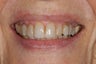 This patient presented with defective restorations and cavities. She had all her teeth top teeth restored with crowns.