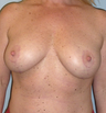 Breast Lift