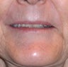 62 Year Old Female Treated for Upper Lip Wrinkles