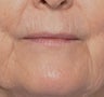 62 Year Old Female Treated for Upper Lip Wrinkles