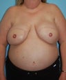 Bilateral DIEP Flap Breast Reconstruction