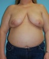 Bilateral DIEP Flap Breast Reconstruction