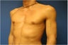 Pectoral Augmentation, Pec Implants