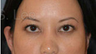 Eyelid