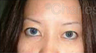 Eyelid