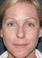Fraxel Laser for Hyperpigmentation
