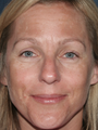 Fraxel Laser for Hyperpigmentation