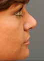 Female Primary Rhinoplasty