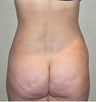 38 Year Old Female Treated For Stomach and Waistline Fat