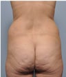 38 Year Old Female Treated For Stomach and Waistline Fat