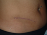 Scar revision of appendectomy scar