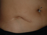 Scar revision of appendectomy scar