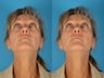 Revision Rhinoplasty Patient