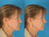 Revision Rhinoplasty Patient