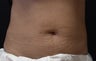 Coolsculpting Abdomen