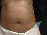Coolsculpting Abdomen