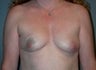 Female patient who underwent breast reconstruction